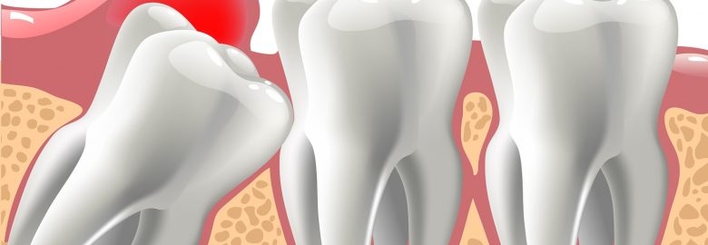 Wisdom Teeth Dentist