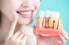 Free Dental Implants Australia